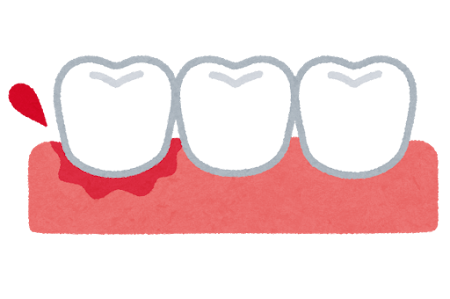 🦷 歯周病の初期症状とは？見逃しがちなサイン